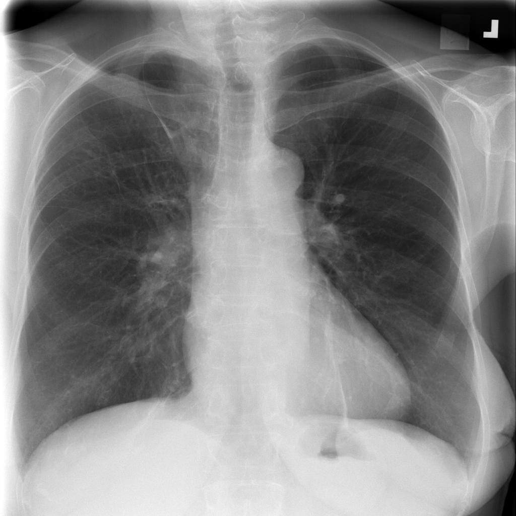 Normal X-ray