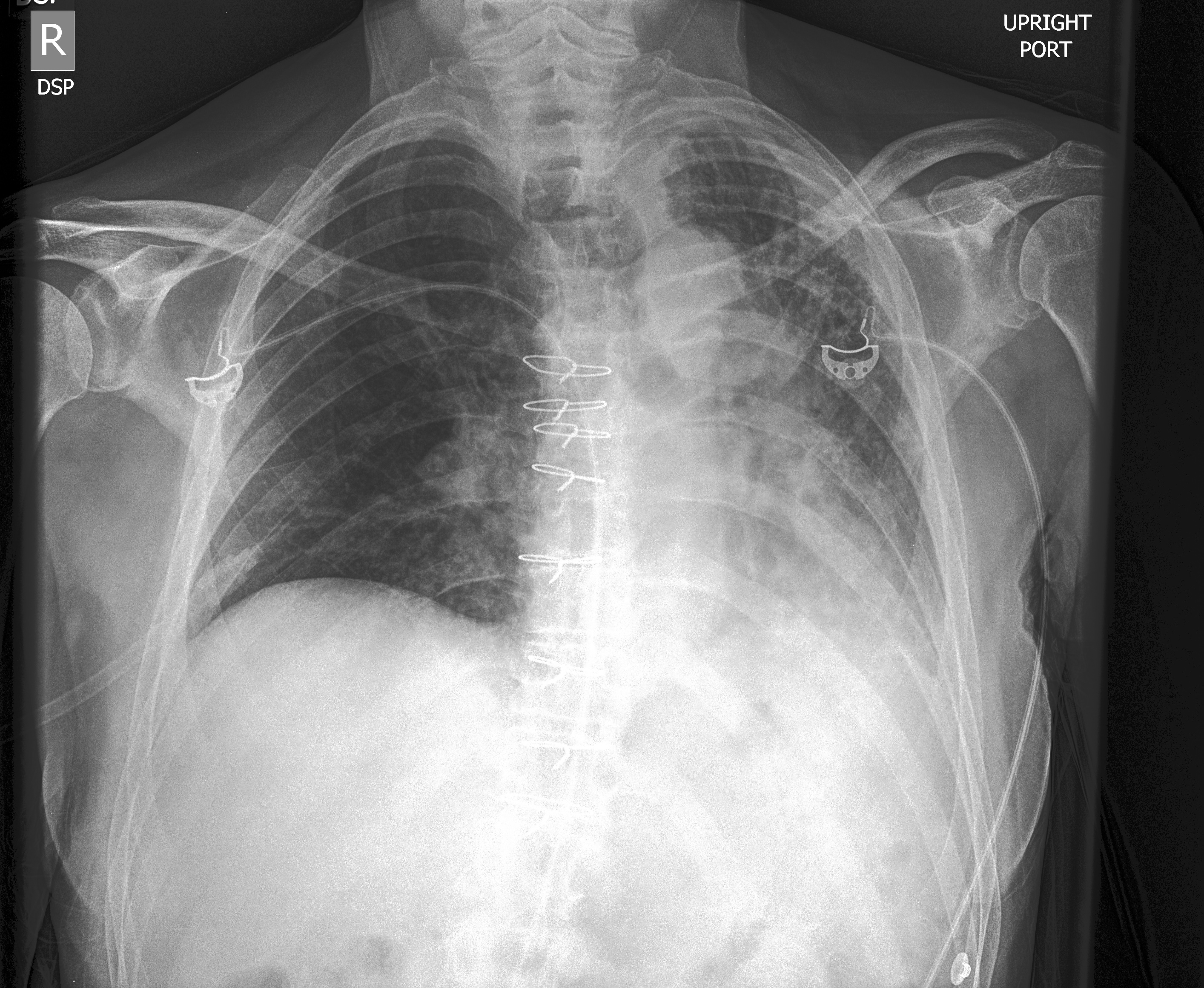 Pneumonia X-ray